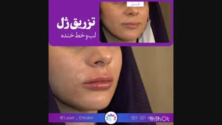 تزریق ژل لب و خط خنده در کلینیک ارکیده