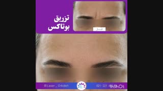 تزریق بوتاکس در کلینیک ارکیده