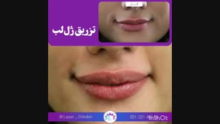 تزریق ژل لب در کلینیک ارکیده