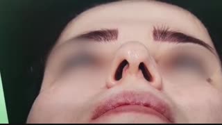 فیلم بلافاصله بعد از جراحی بینی