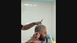 مستند کاشت مو و مراحل آن