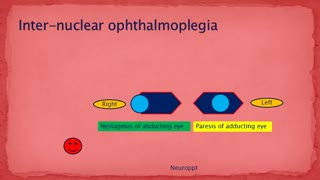اینتر نوکلئار افتالموپلژی