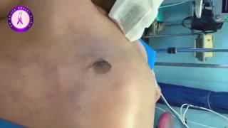 ژنیکوماستی آقای 30 ساله