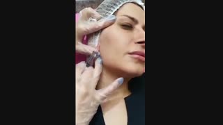 فیلم تزریق پروفایلو