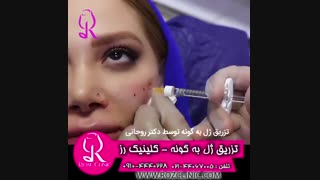 فیلم تزریق ژل | کلینیک رز | 09104440228 | شماره 187