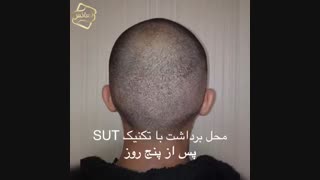 کاشت مو | کلینیک تخصصی رنسانس  021-22088210