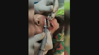 کامپوزیت فک پایین با حداقل تراش