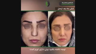جراحی بینی در بیمار با بینی کوتاه و گوشتی | دکتر باستانی نژاد