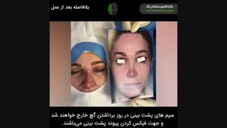 جراحی ترمیمی بینی برای بار چهارم | دکتر باستانی نژاد