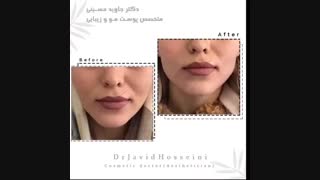 فیلم کانتورینگ زاویه فک