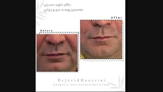 فیلم تزریق خط خنده