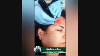 میکرونیدلینگ صورت