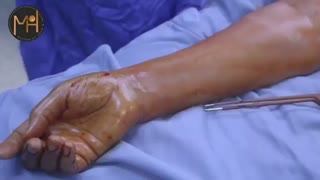 فیلم جراحی تومور چشمی