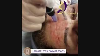 فیلم میکرونیدلینگ با prp