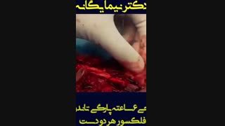 فیلم عمل جراحى ٦ ساعته پارگى تاندون هاى فلکسور هر دو دست