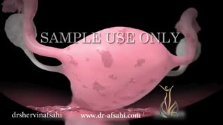 اندومتریوز چیست و علائم آن