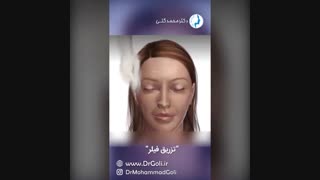 انیمیشن تزریق فیلر | دکتر محمد گلی