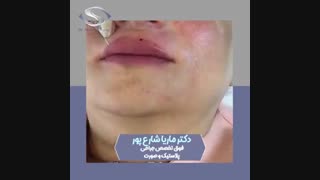 فیلم تزریق فیلر لب