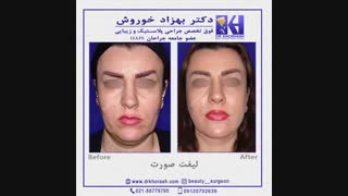 نمونه کار لیفت صورت