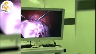 لاپاراسکوپی هیسترکتومی