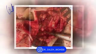 جراحی همزمان تومور پاروتید و رینوپلاستی