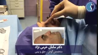 جلراحی بینی استخوانی به روش بسته