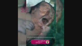 فیلم واقعی زایمان سزارین توسط دکتر سیده فاطمه سیدی لیفت صورت