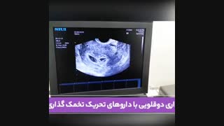سونوگرافی بارداری دوقلویی باداروهای تحریک تخمک گذاری