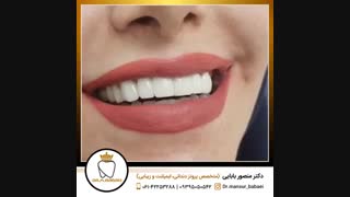 طراحی لبخند کلینیک دکتر منصور بابایی برداشتن خال