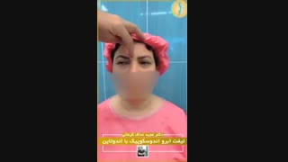 فیلم جراحی لیفت اندوسکوپیک ابرو با اندوتاین