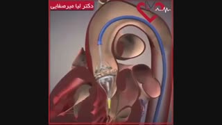 فیلم ترمیم تنگی دریچه آیٔورت