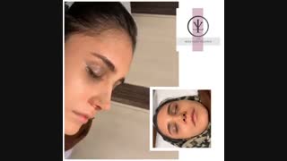 فیلم جراحی بینی استخوانی