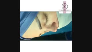 فیلم جراحی بینی گوشتی