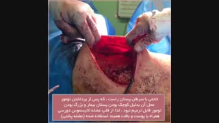 فیلم خانمی با سرطان پستان و برداشتن تومور