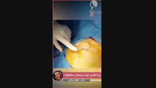 فیلم برداشتن توده پستان