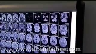 نورالژی عصب پنجم(تری ژمینال)ثانویه به تومور اپیدرموئید CPA