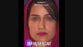 فیلم عمل بینی با انحراف شدید