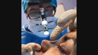 جراحی بینی نیمه فانتری