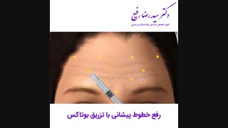 رفع خطوط پیشانی با بوتاکس