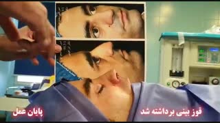 اصلاح کجی شدید بینی توسط جراح بینی تهران دکتر امید ابراهیمی