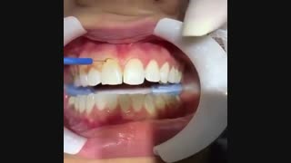 جراحی لثه با لیزر ابرسانی پوست