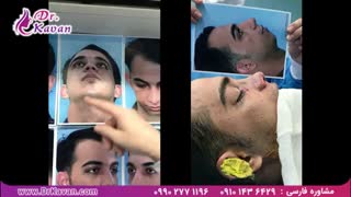 عمل زیبایی بینی و گوش به صورت همزمان توسط دکتر کاوان