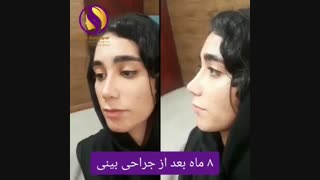 نتایج شگفت انگیز  بعد از جراحی بینی