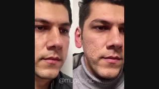 فیلم درمان جای جوش باسابسیژن + الانسه ارتودنسی