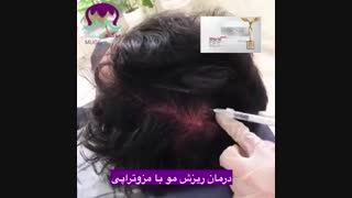 فیلم مزوتراپی مو برای چه کسانی موثر است؟