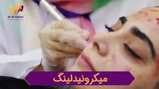 فیلم میکرونیدلینگ بلیچینگ