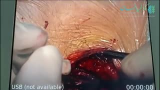 عمل جراحی میکروسکوپیک دیسک کمر