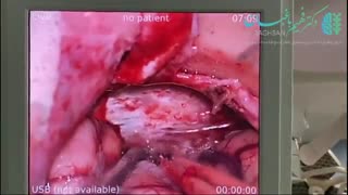 جراحی تومور مننژیومای کلینوئید و فالکس