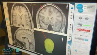 شانت گذاری در بیمار 16 ساله با تشخیص پسودوتومور سربری