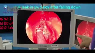 نشت مایع مغزی نخاعی در اثر حادثه سقوط از ارتفاع